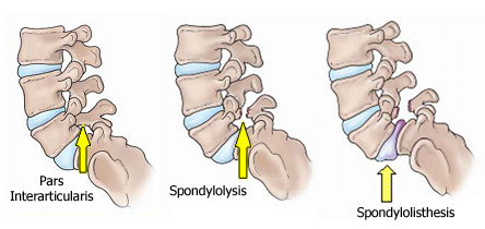 Spondylosis: learn about symptoms and treatment